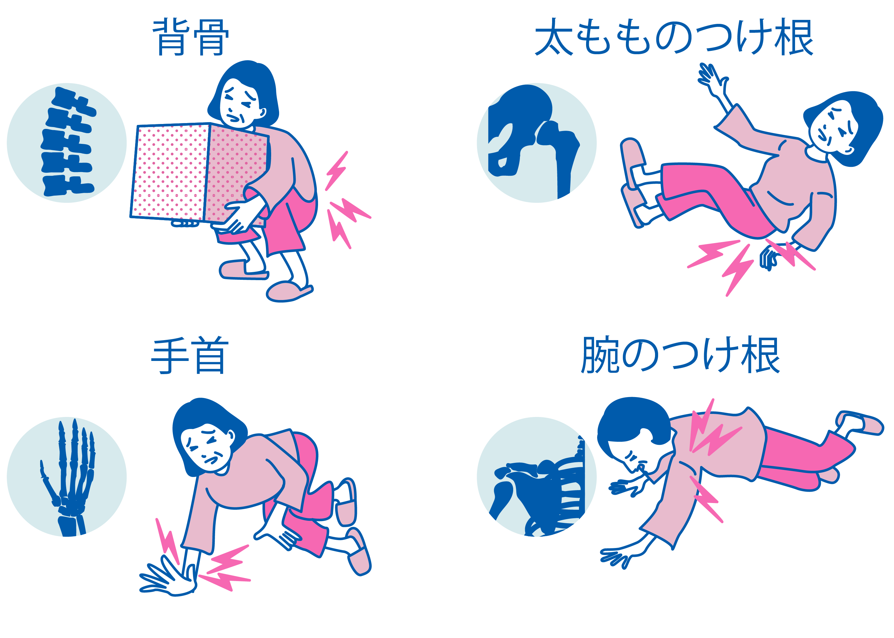 骨折しやすい箇所のイメージ画像